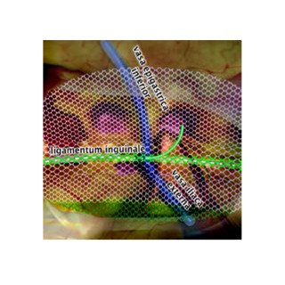 Dynamesh Endolap 3D