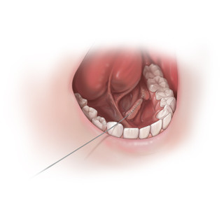 Scialoendoscopia Interventistica