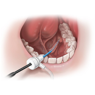 Scialoendoscopia Interventistica