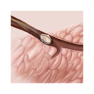 Scialoendoscopia Interventistica