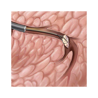 Scialoendoscopia Interventistica