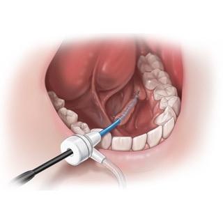 Scialoendoscopia Interventistica