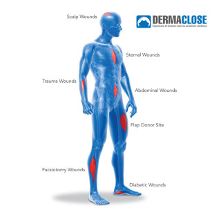 DERMACLOSE